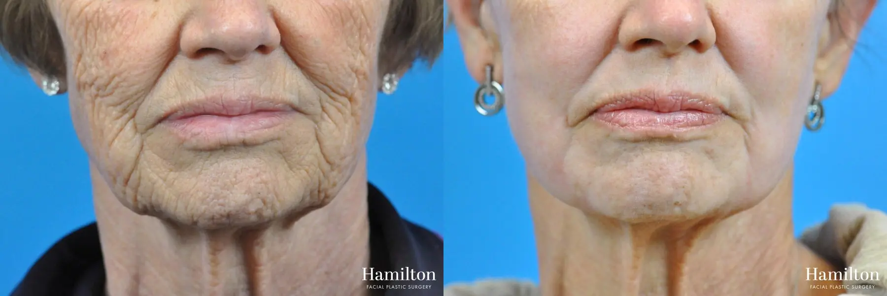 C02 Laser: Patient 6 - Before and After 2