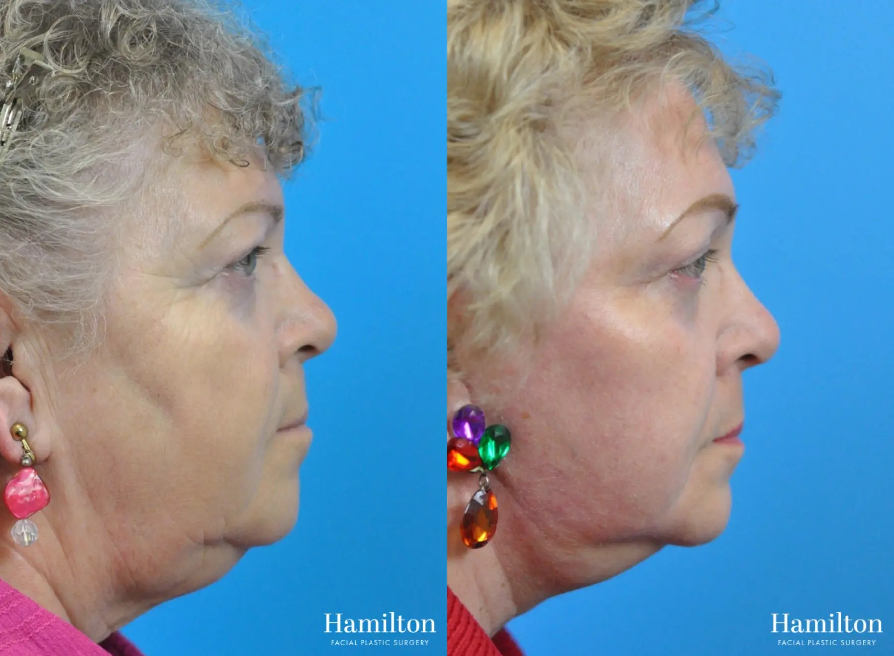 C02 Laser: Patient 9 - Before and After 4