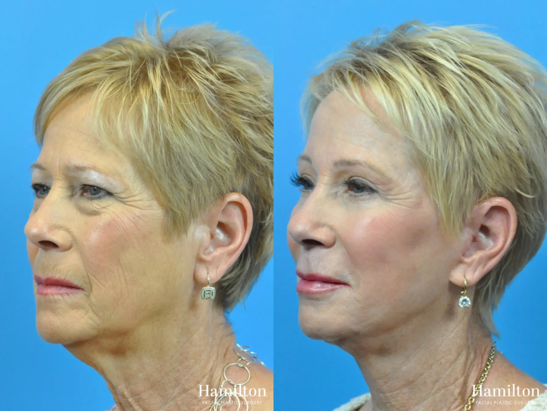 C02 Laser: Patient 2 - Before and After 1