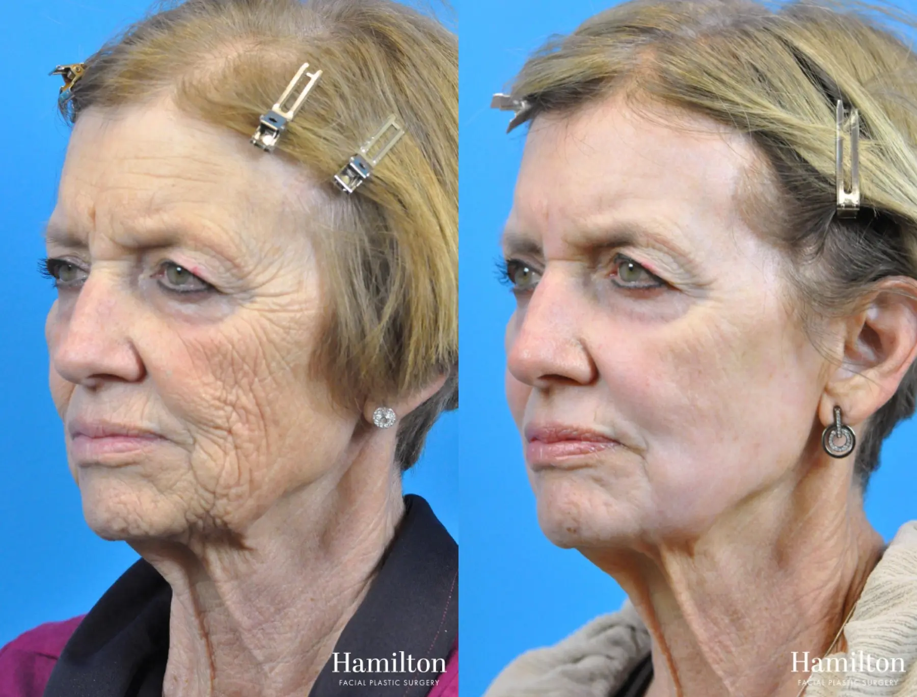 C02 Laser: Patient 6 - Before and After 4