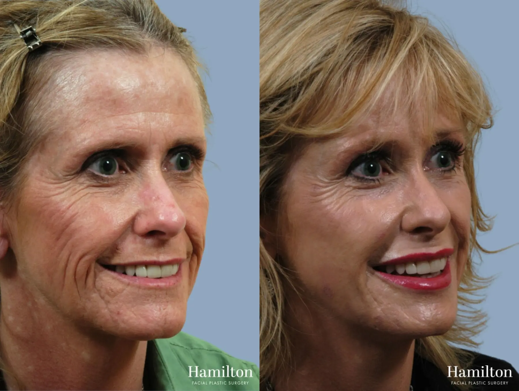 C02 Laser: Patient 5 - Before and After 3