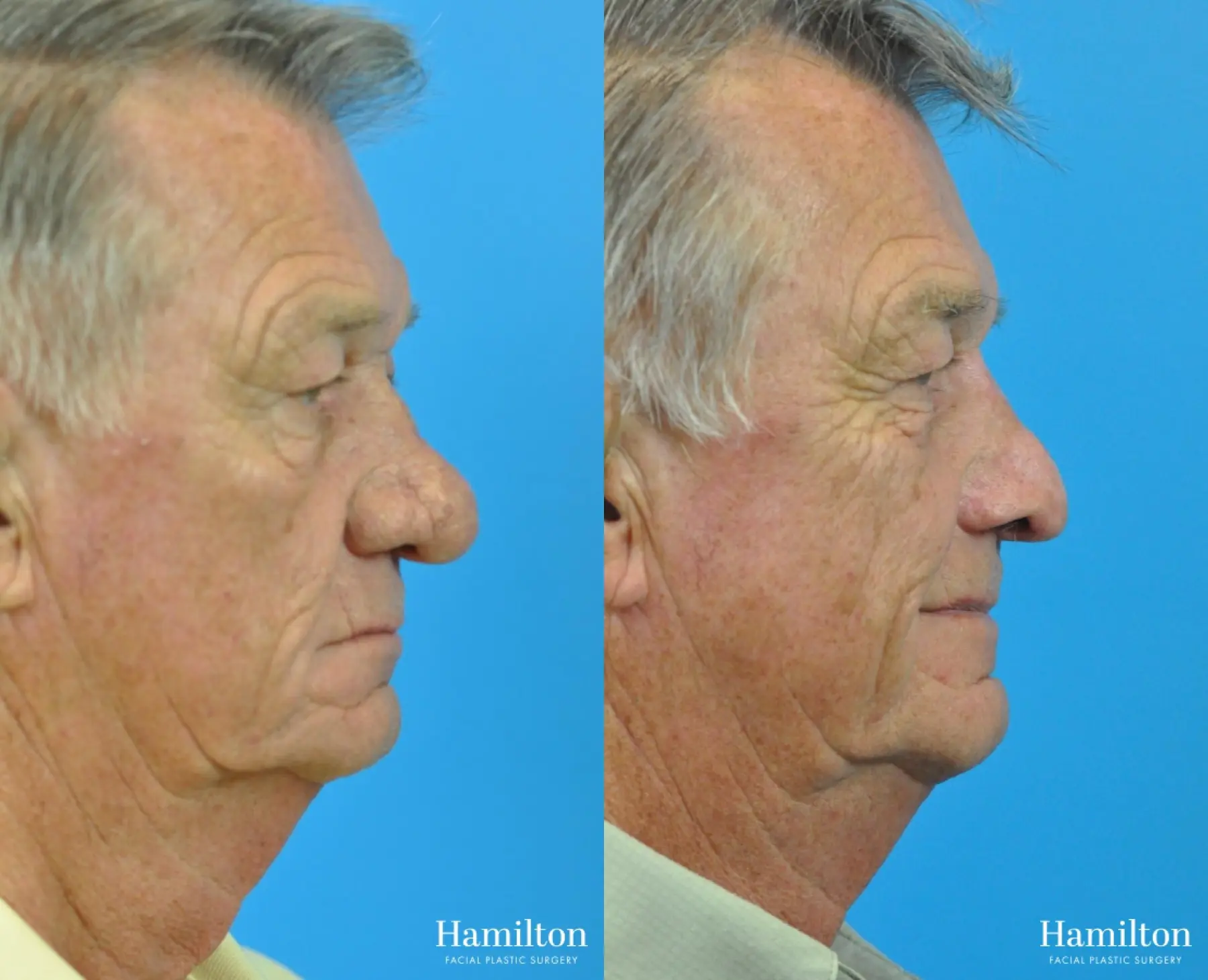 C02 Laser: Patient 7 - Before and After 2