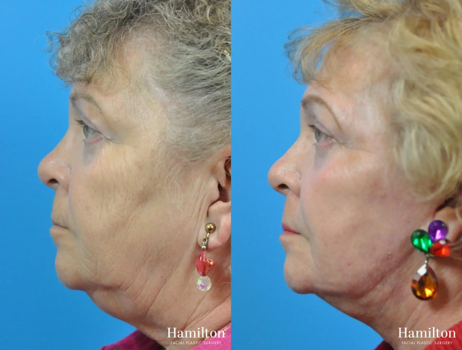 C02 Laser: Patient 9 - Before and After 2