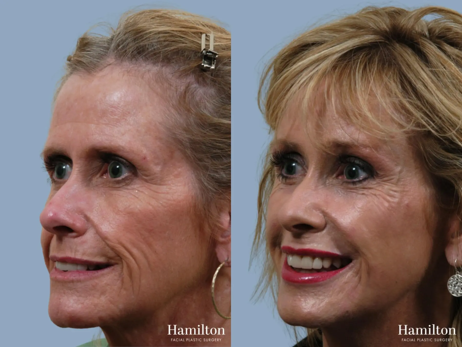 C02 Laser: Patient 5 - Before and After 2