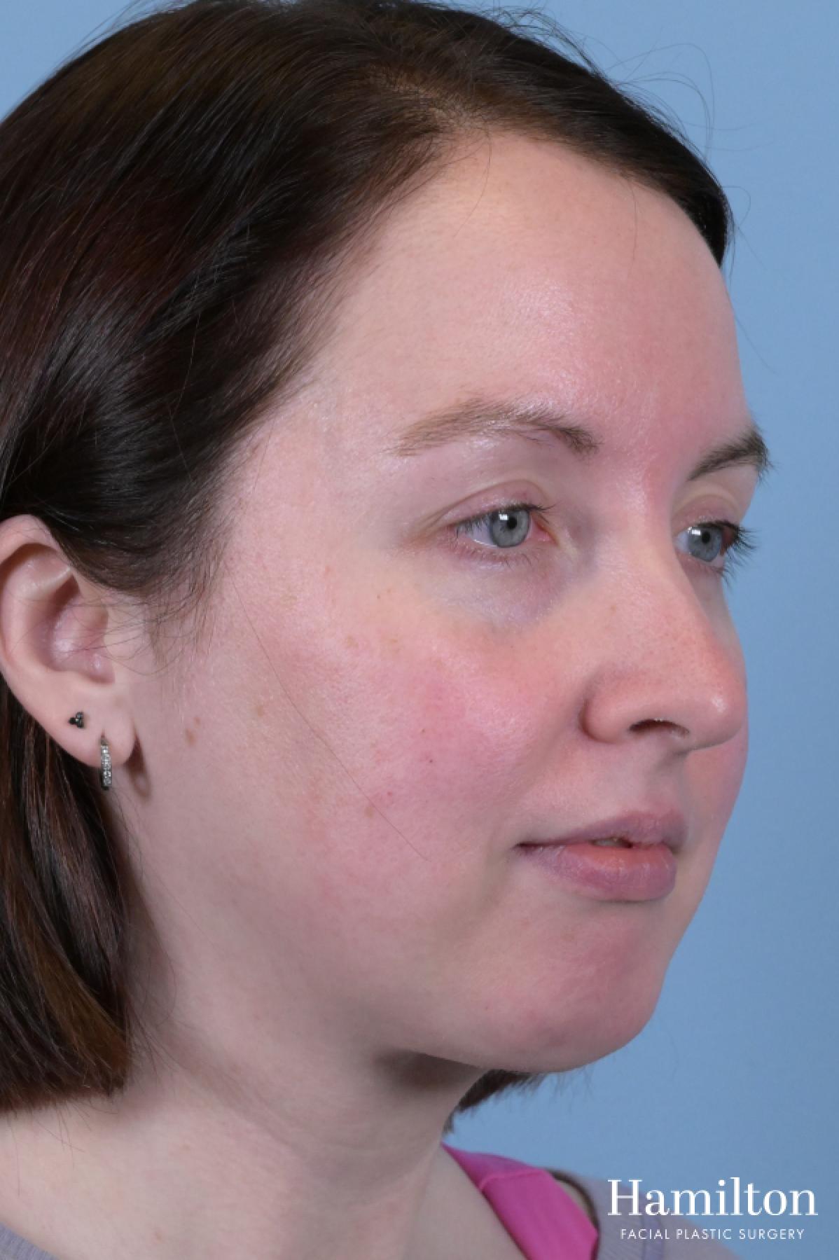 Submentoplasty/Deep Neck Lift: Patient 1 - After 5