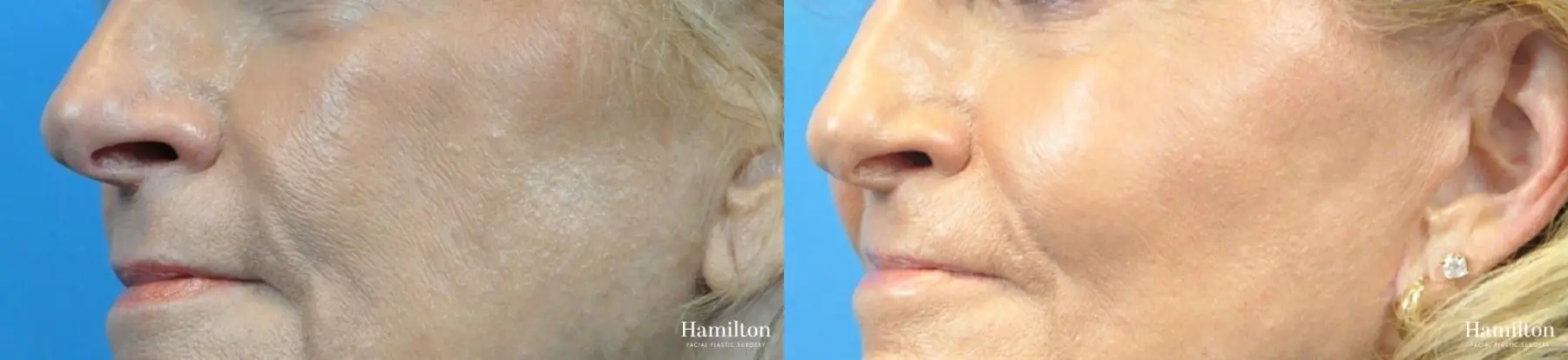 Cheek Augmentation: Patient 1 - Before and After 2