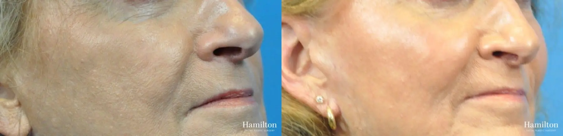 Cheek Augmentation: Patient 1 - Before and After  