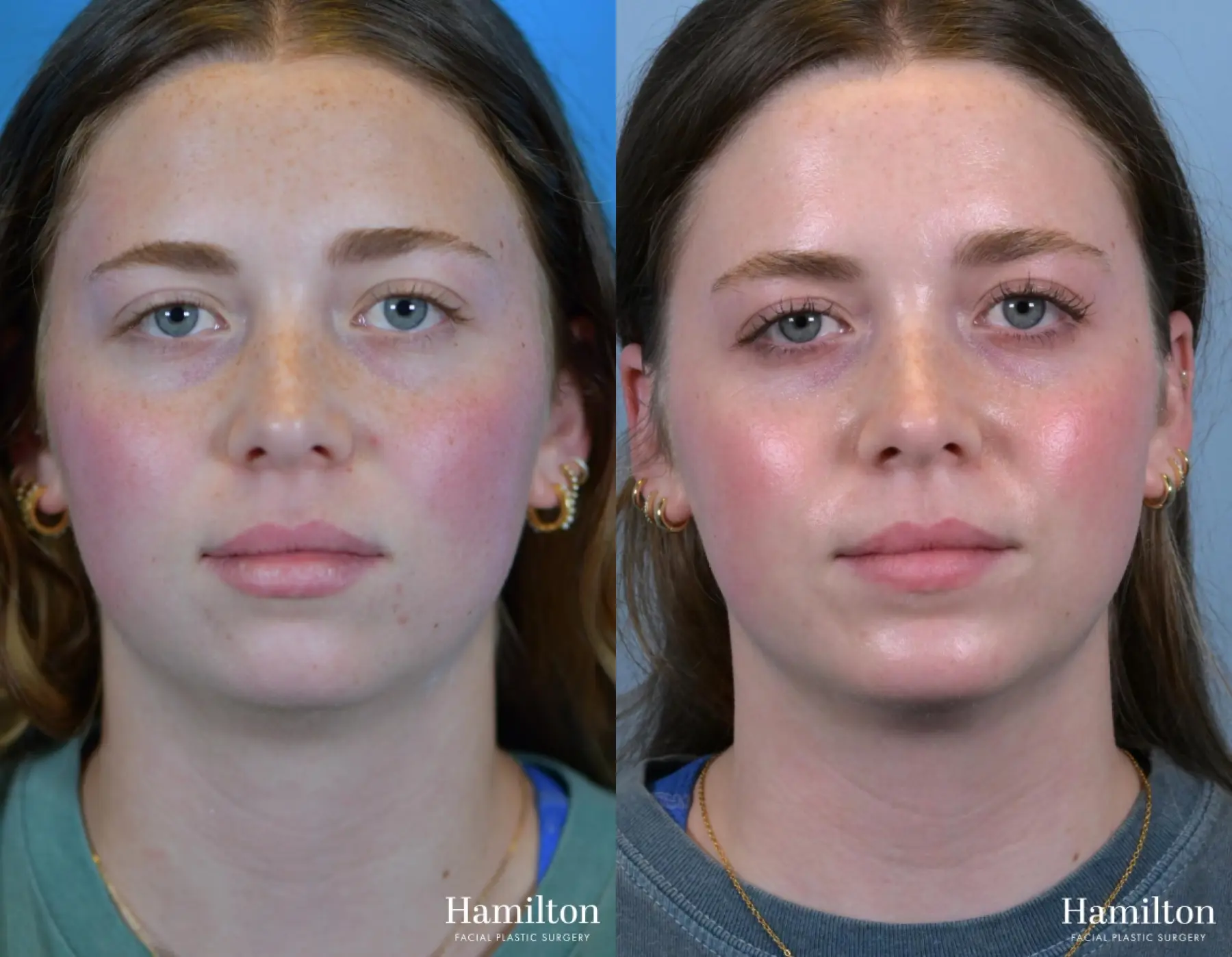 Chin Augmentation: Patient 6 - Before and After 2