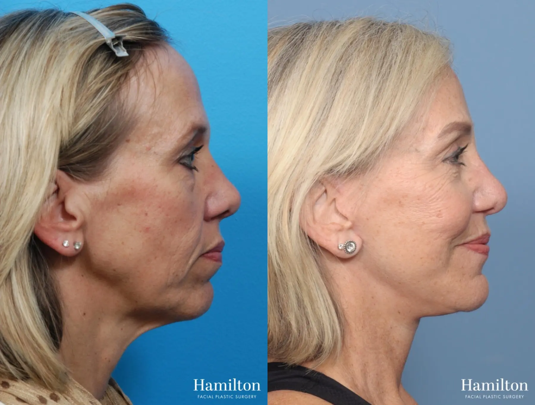 Chin Augmentation: Patient 2 - Before and After 1