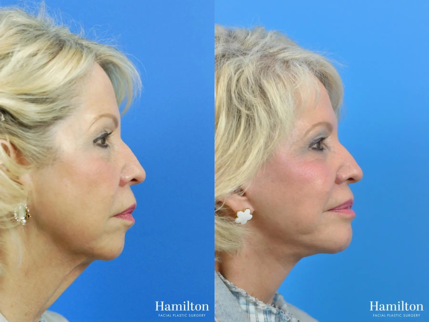 Chin Augmentation: Patient 3 - Before and After 1