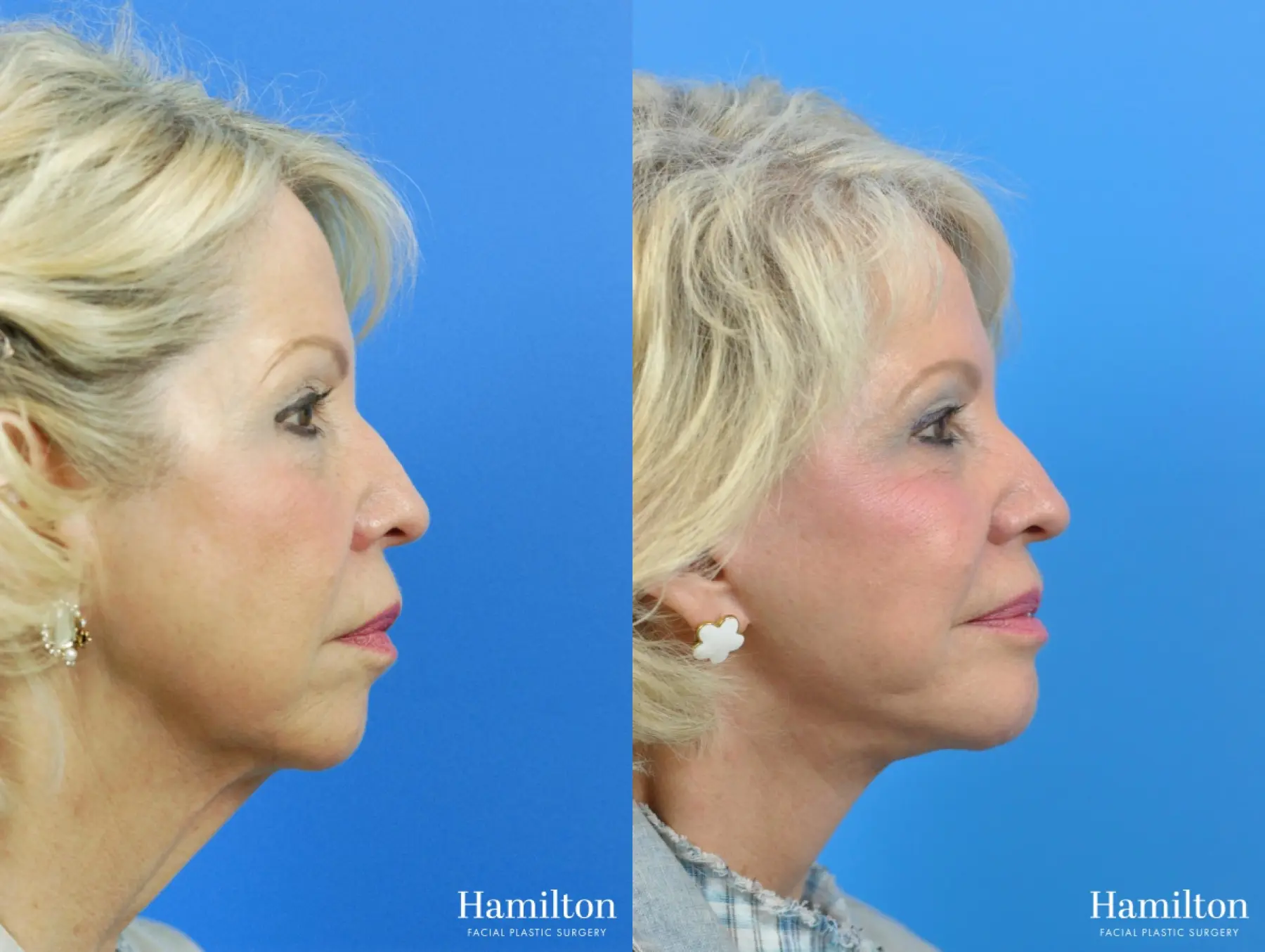 Chin Augmentation: Patient 3 - Before and After  