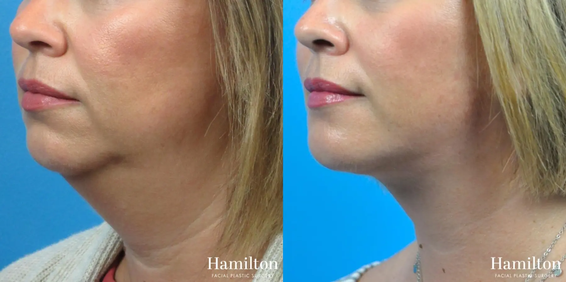 Chin Augmentation: Patient 1 - Before and After 3