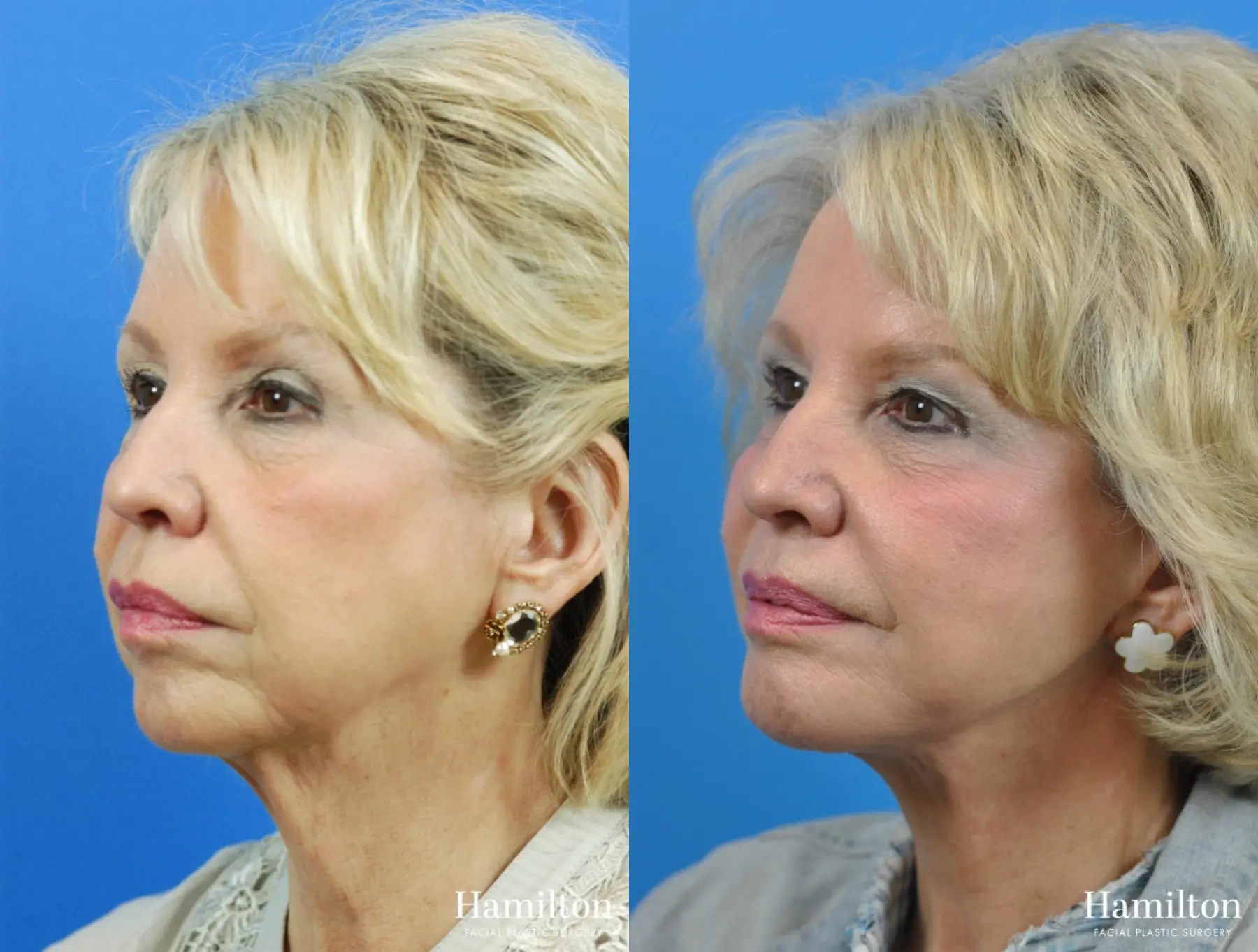 Chin Augmentation: Patient 3 - Before and After 4