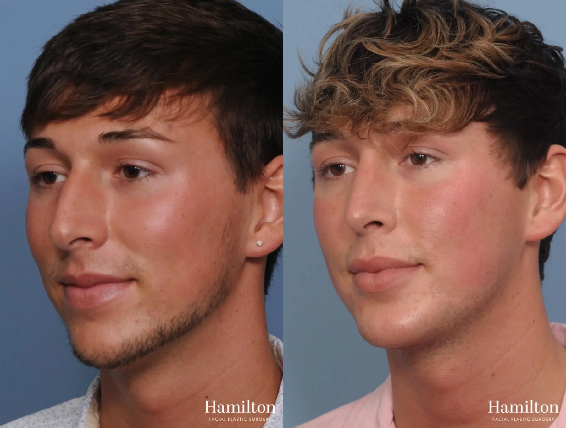 Chin Augmentation: Patient 1 - Before and After 3