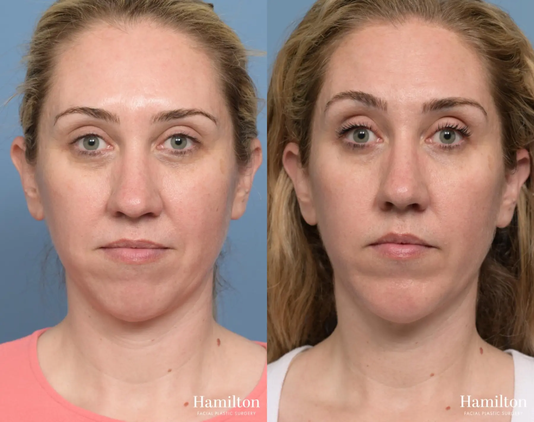 Chin Augmentation: Patient 2 - Before and After 5