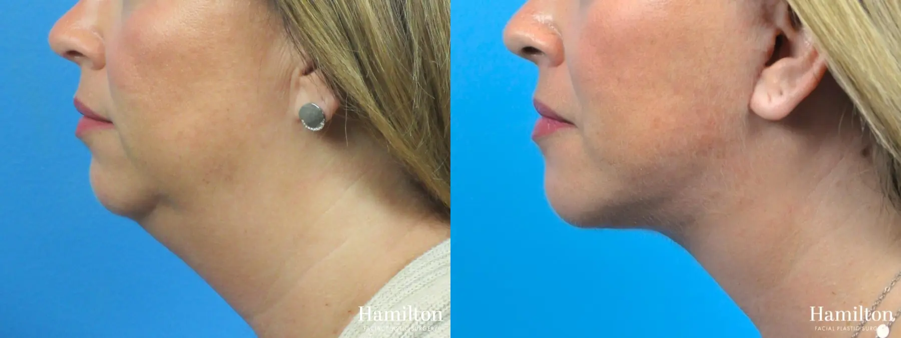 Chin Augmentation: Patient 1 - Before and After 1