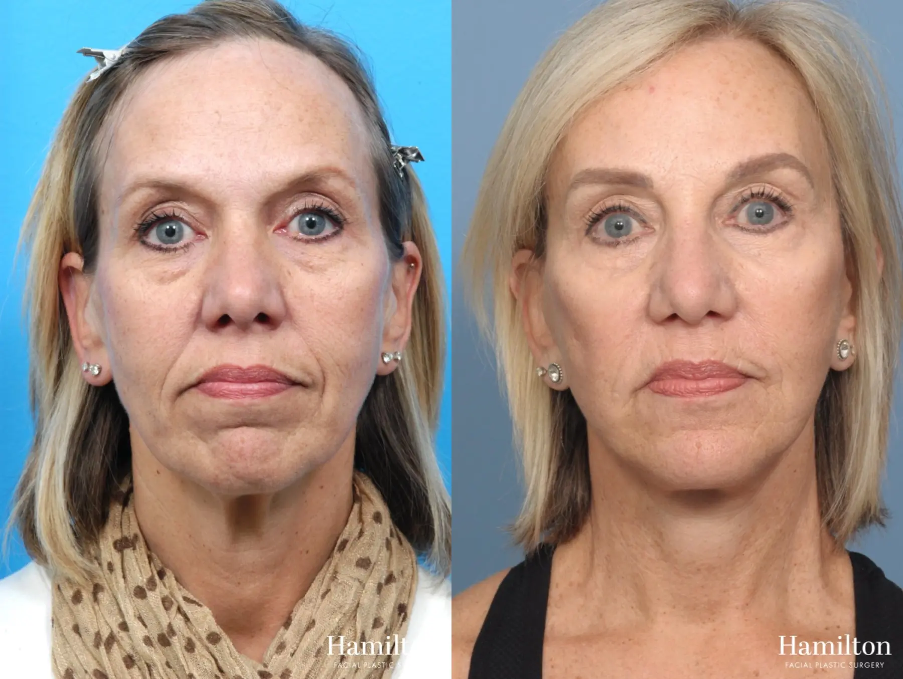 Chin Augmentation: Patient 6 - Before and After 2