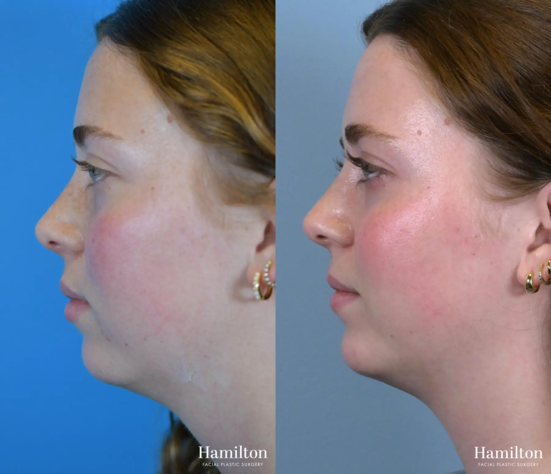 Chin Augmentation: Patient 6 - Before and After 4