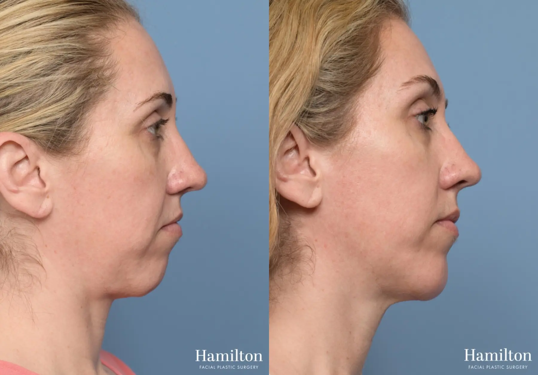 Chin Augmentation: Patient 2 - Before and After 2