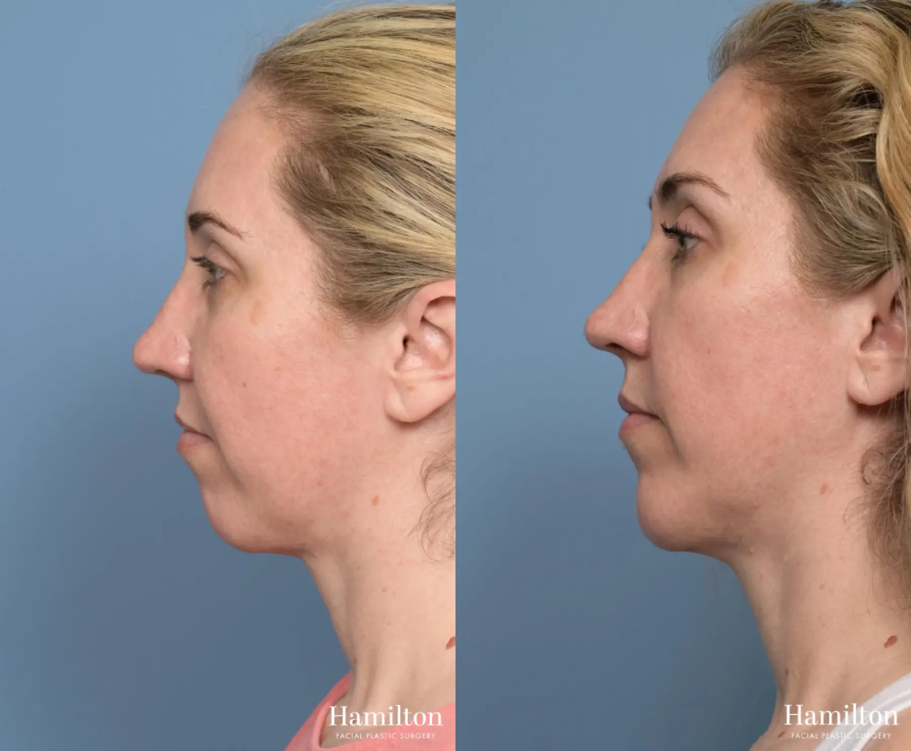 Chin Augmentation: Patient 2 - Before and After 1