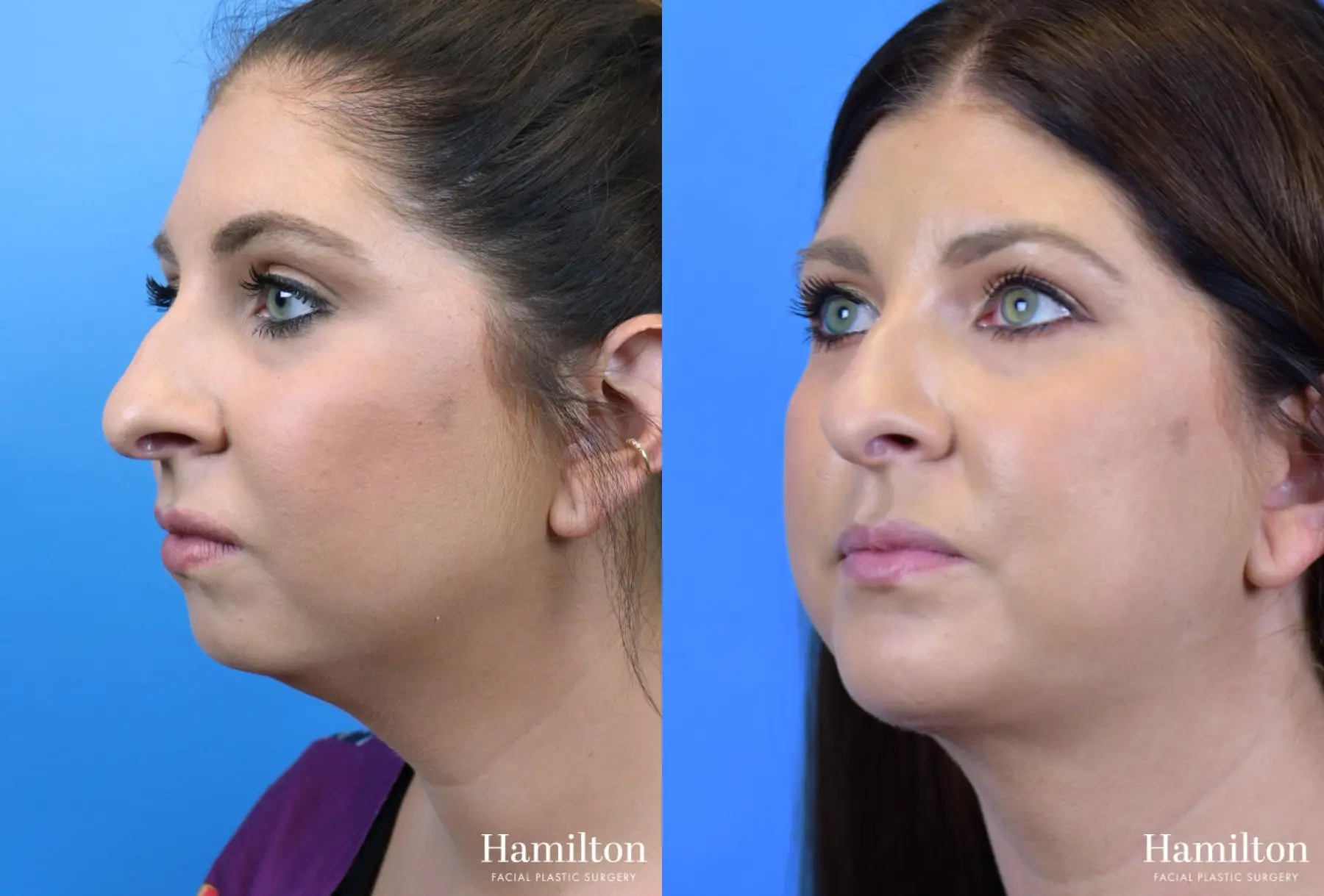 Chin Augmentation: Patient 10 - Before and After 2