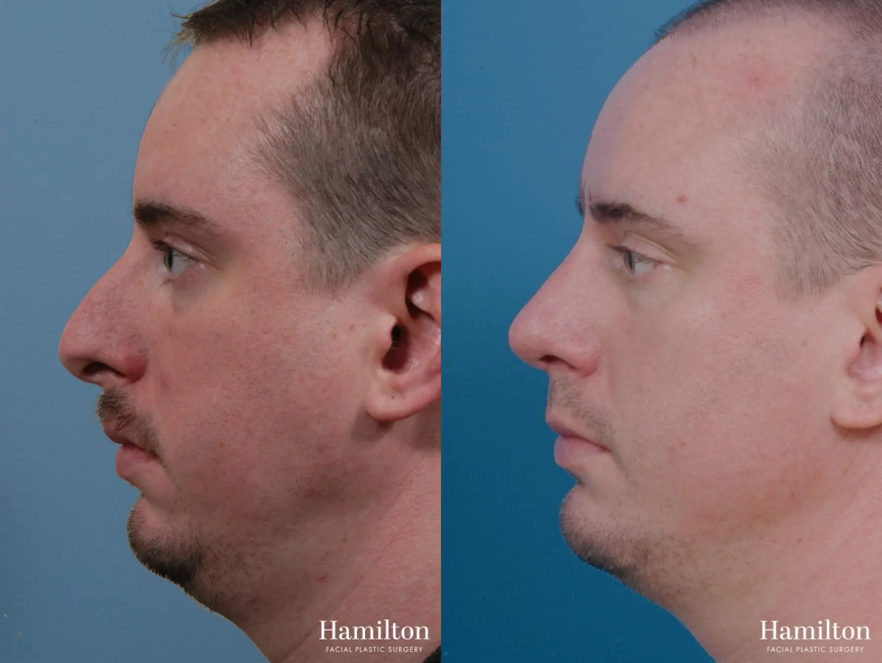 Chin Augmentation: Patient 9 - Before and After 1