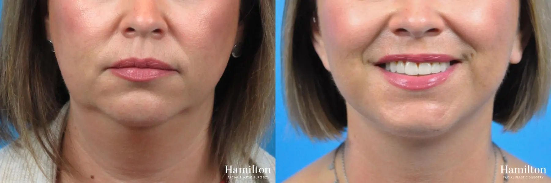 Chin Augmentation: Patient 1 - Before and After 2