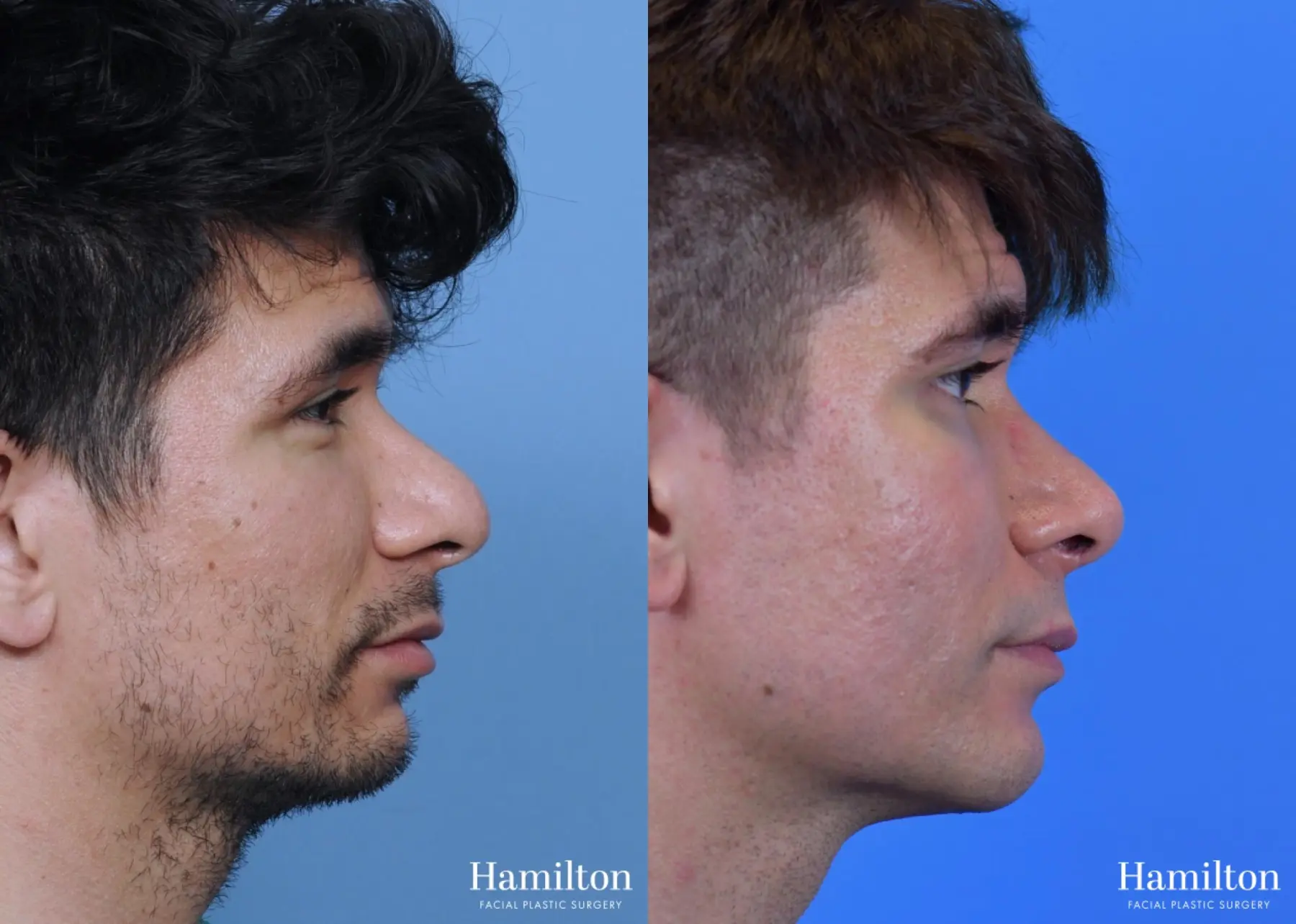 Chin Augmentation: Patient 8 - Before and After  