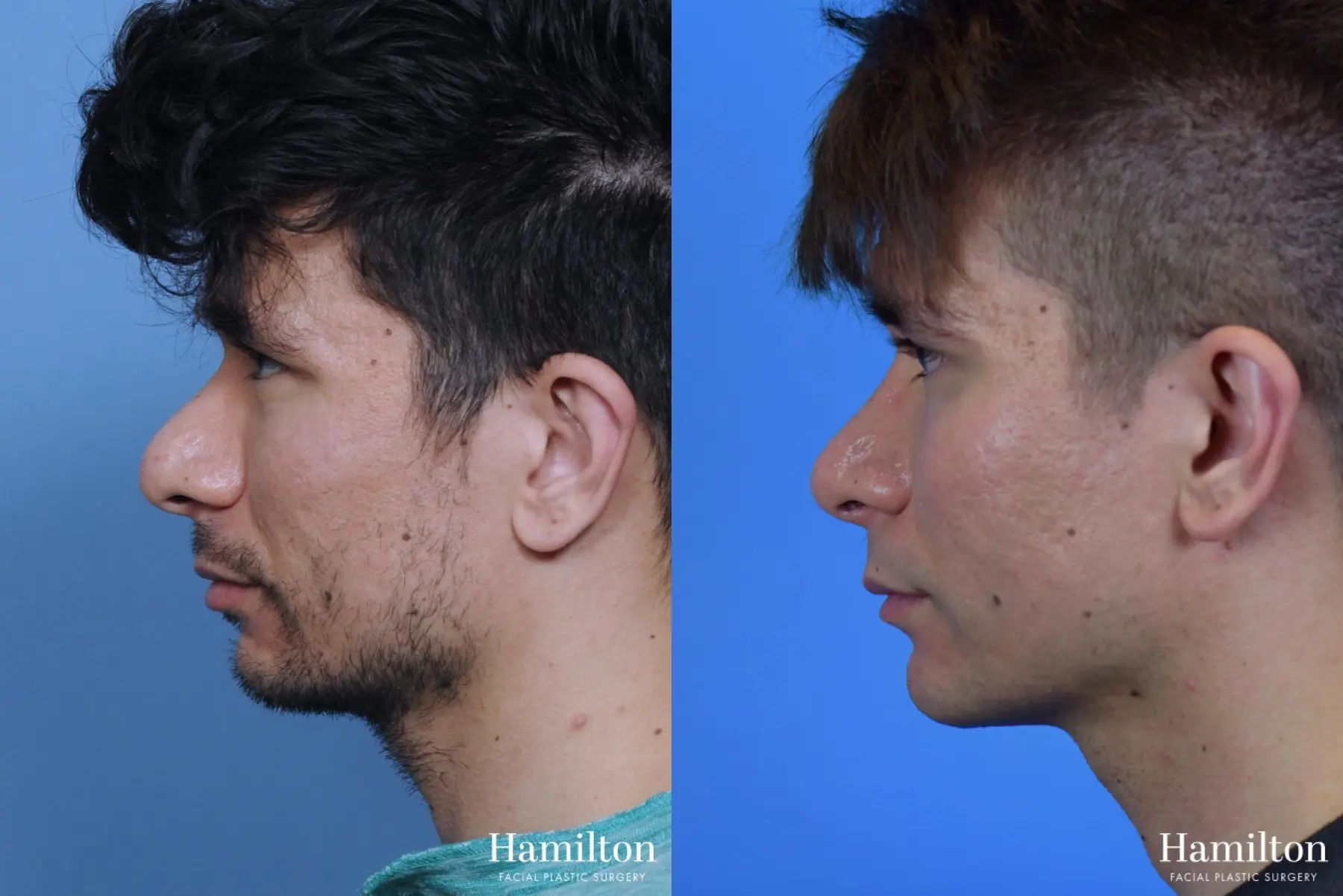 Chin Augmentation: Patient 8 - Before and After 2