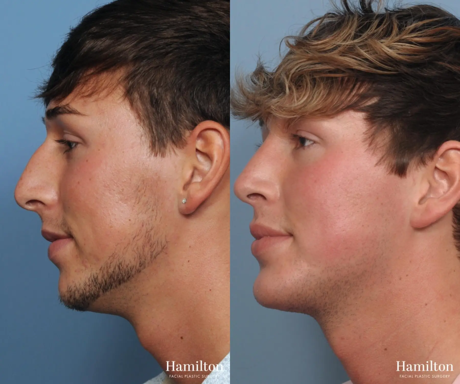 Chin Augmentation: Patient 2 - Before and After  