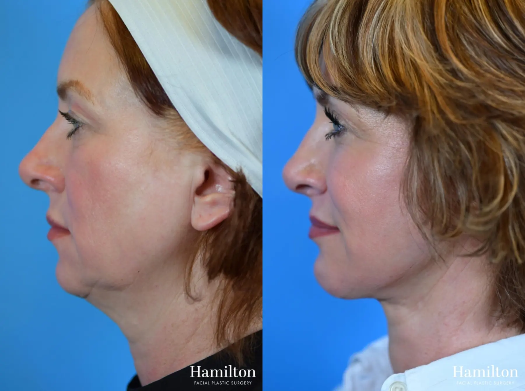 Chin Augmentation: Patient 5 - Before and After 1