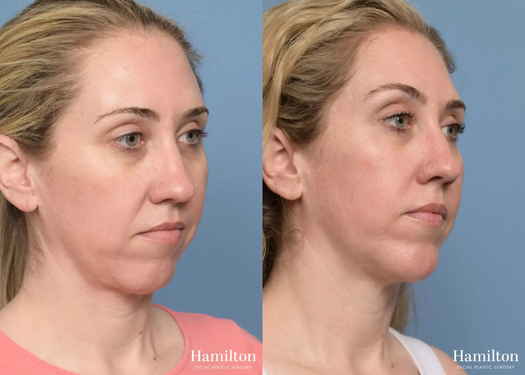 Chin Augmentation: Patient 2 - Before and After 4