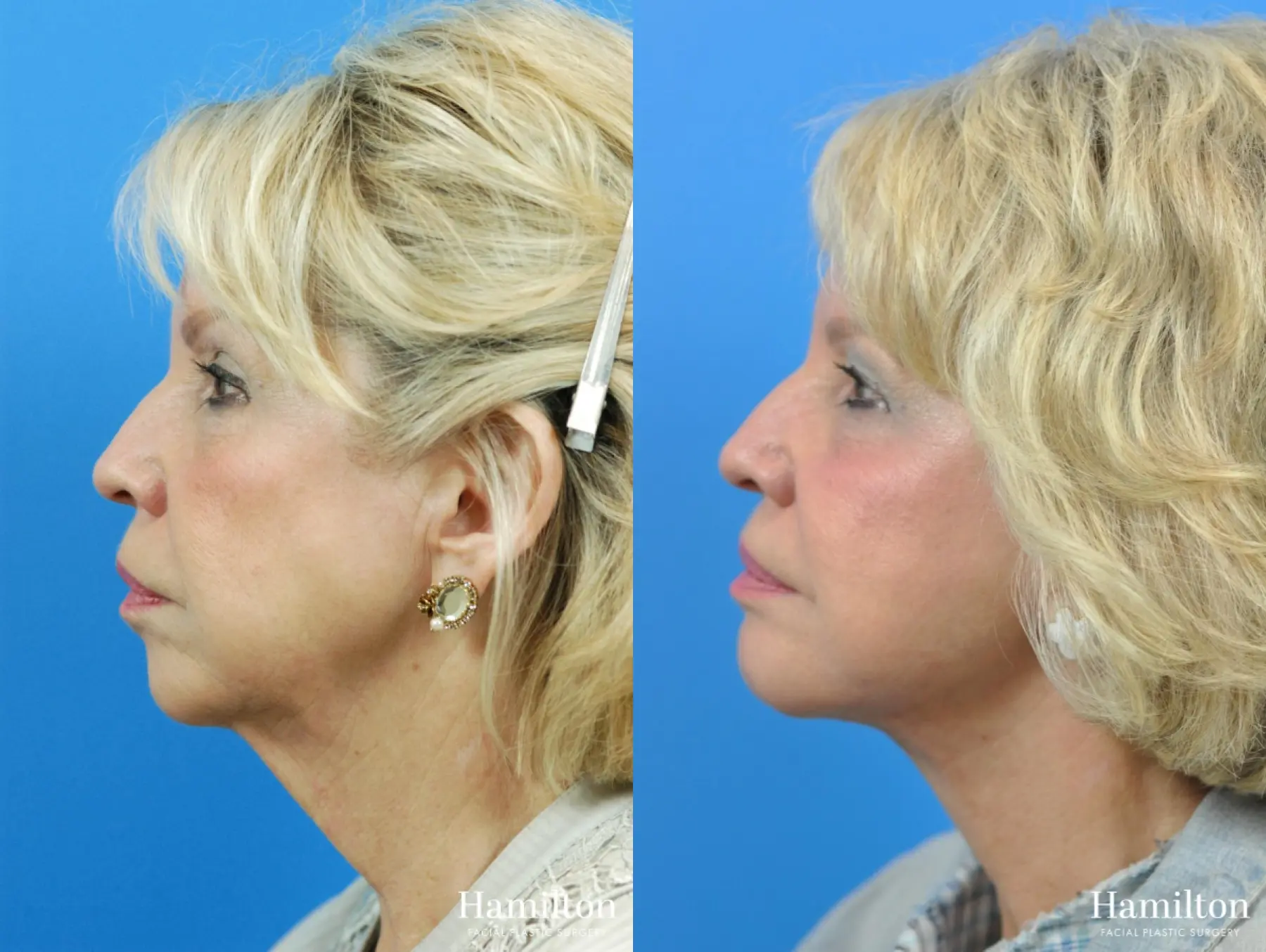 Chin Augmentation: Patient 3 - Before and After 3