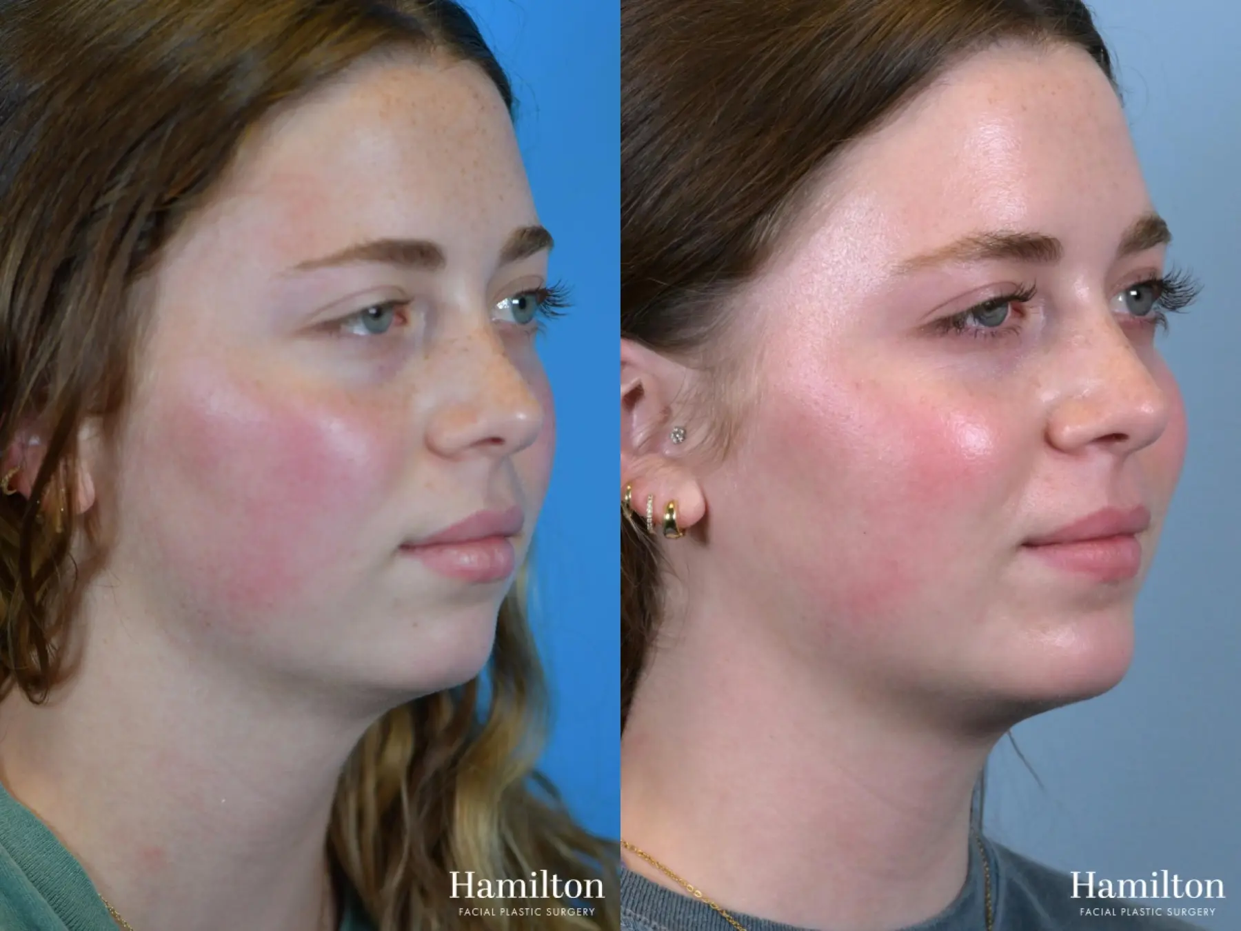 Chin Augmentation: Patient 6 - Before and After  