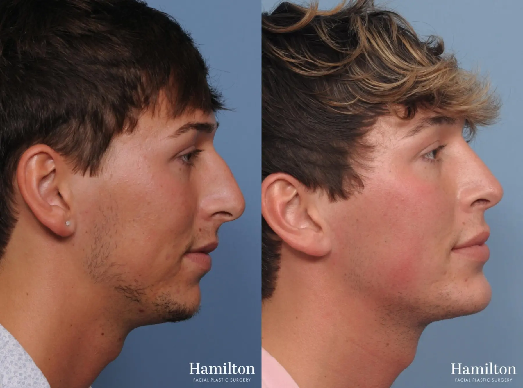 Chin Augmentation: Patient 1 - Before and After 2