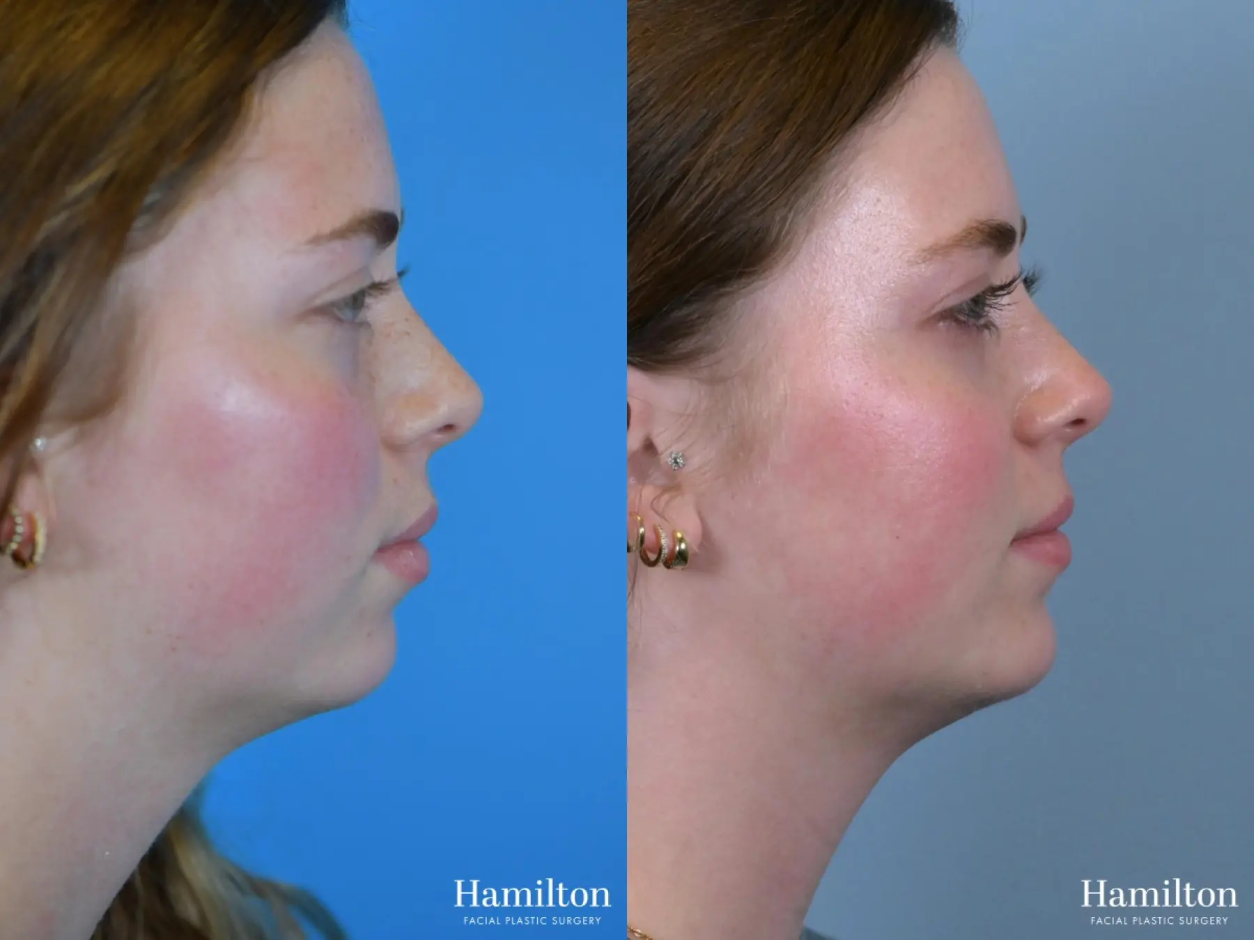 Chin Augmentation: Patient 6 - Before and After 3