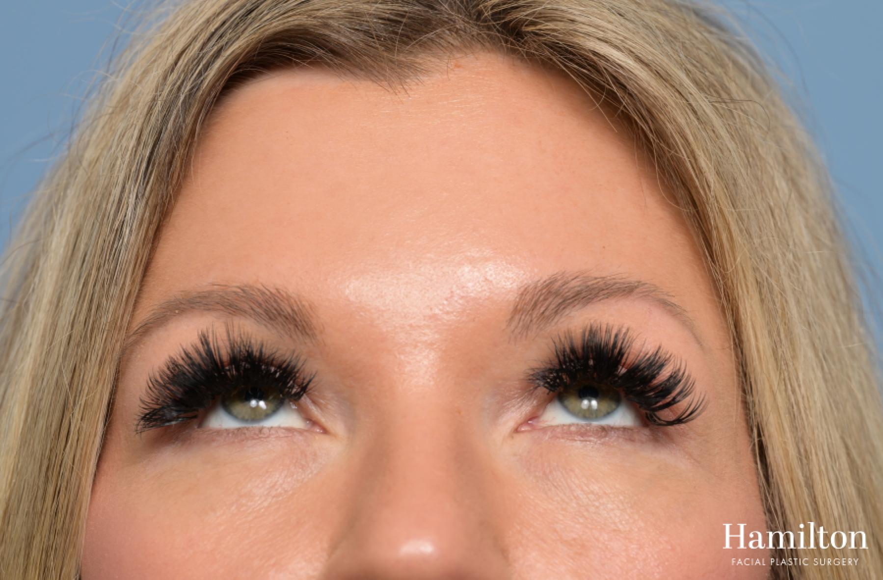Blepharoplasty: Patient 4 - After 4