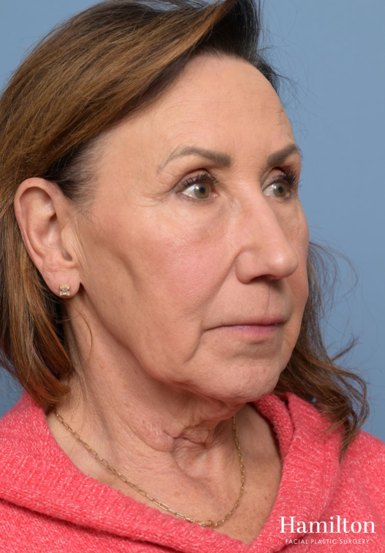 Facelift: Patient 9 - Before 2