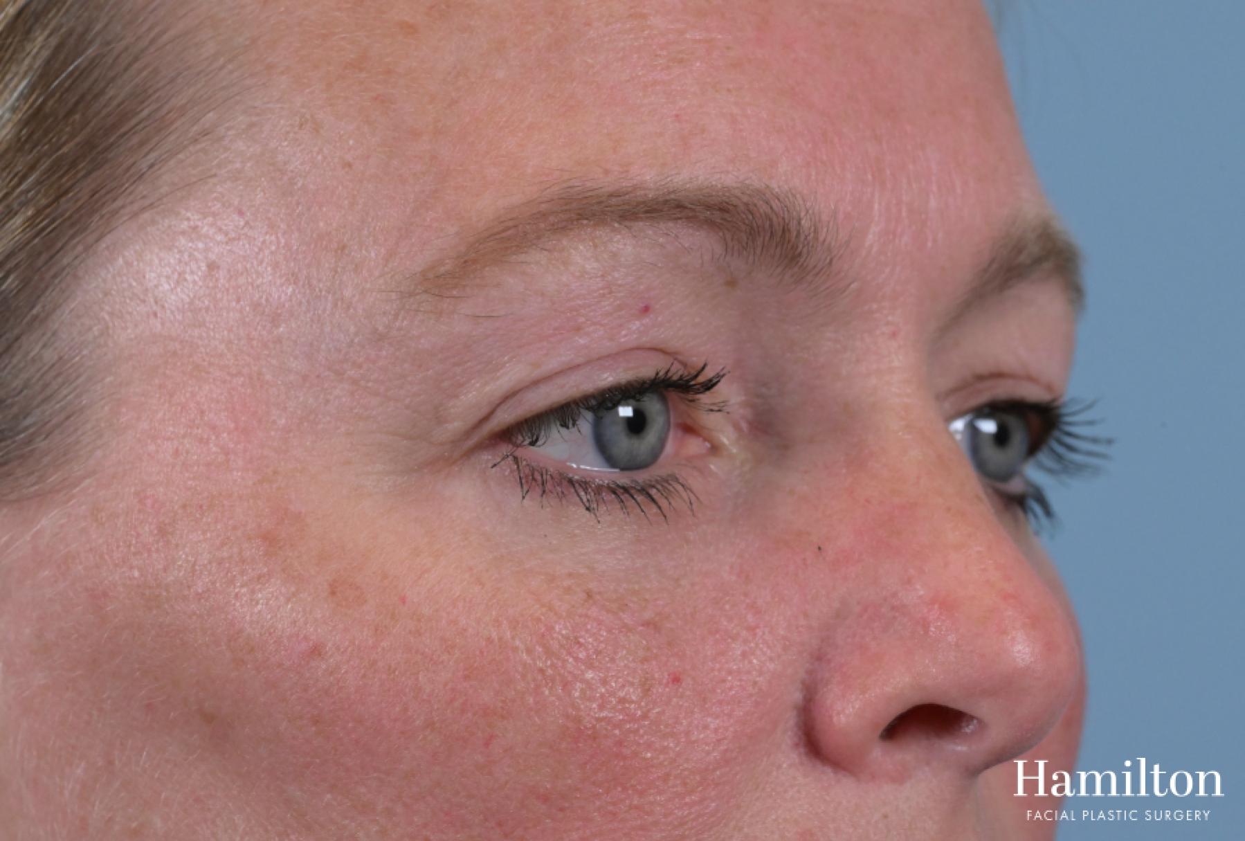 Blepharoplasty: Patient 2 - After 3