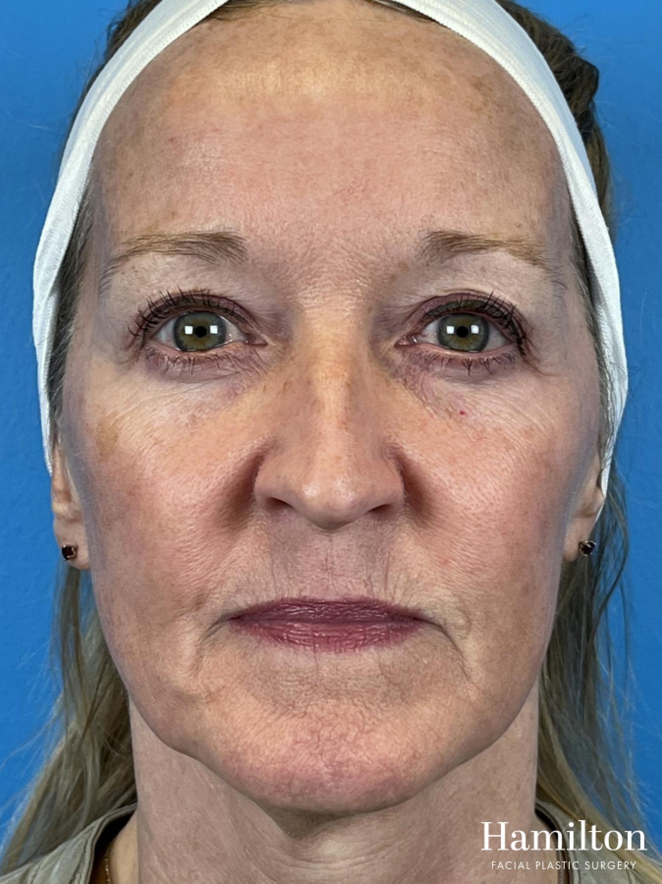 Broad Band Light (BBL): Patient 1 - After 4