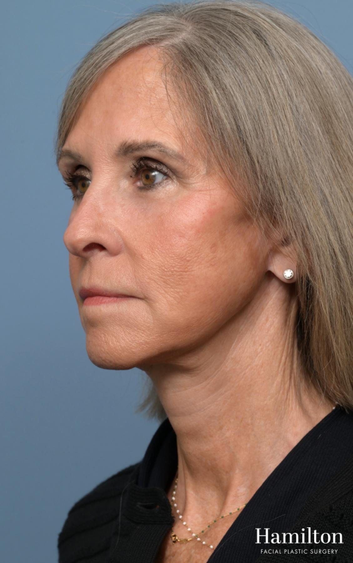 Fat Grafting: Patient 1 - After 4_2