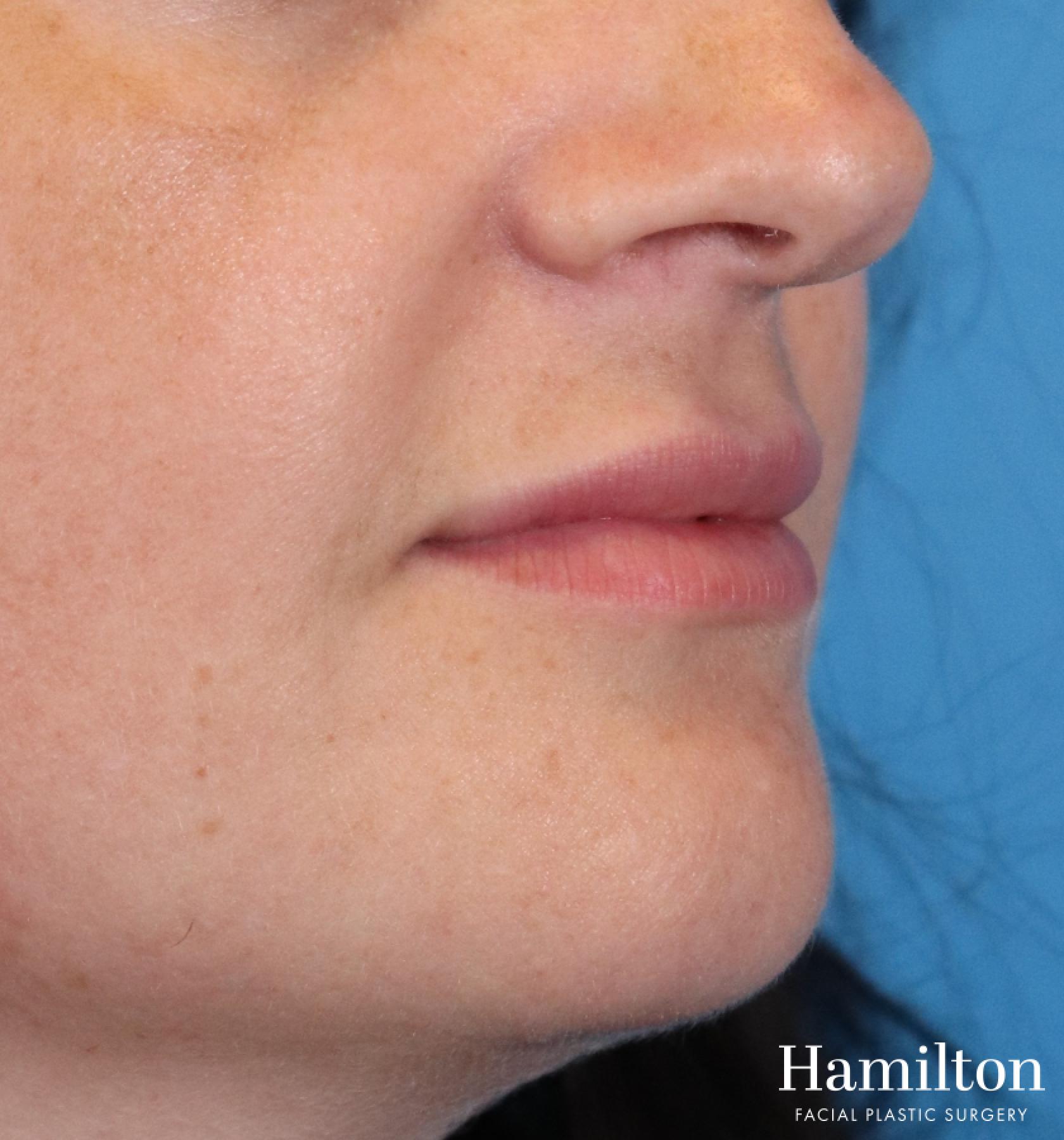Lip Enhancement: Patient 5 - After  