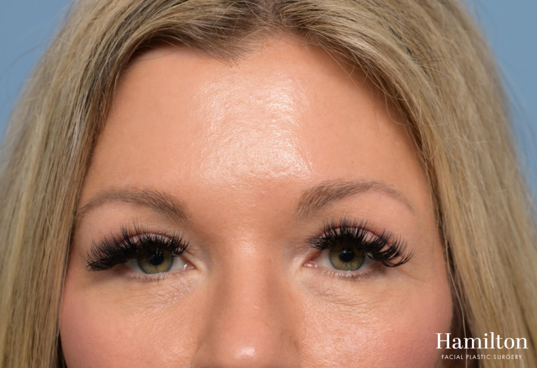Blepharoplasty: Patient 4 - After  