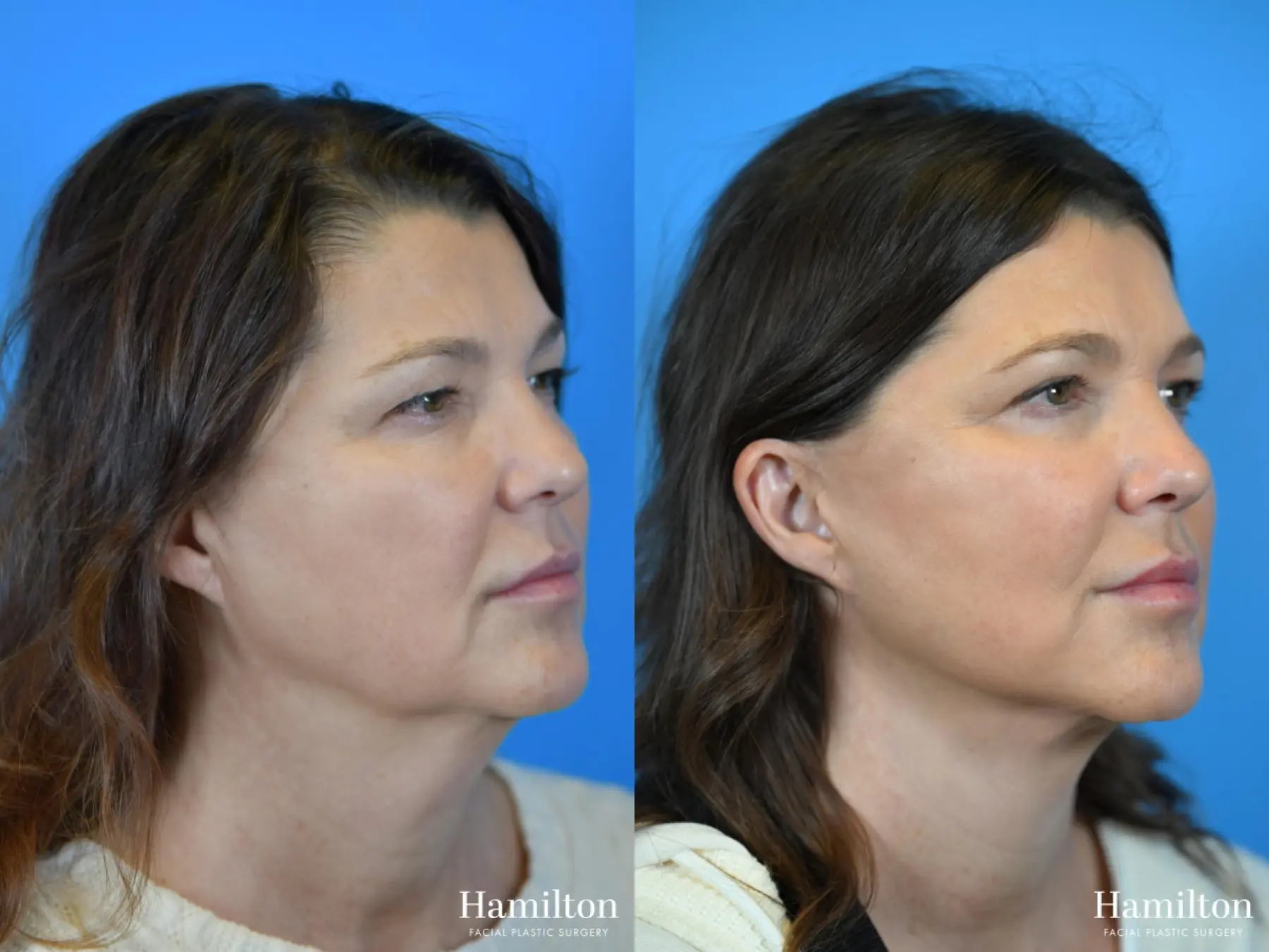 Facelift: Patient 15 - Before and After 2
