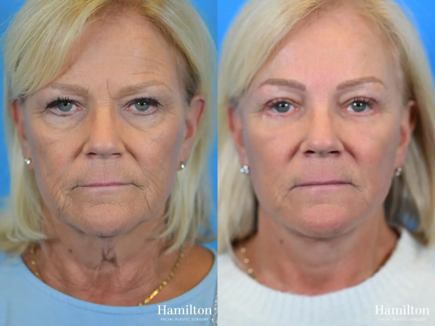 Facelift: Patient 11 - Before and After 2