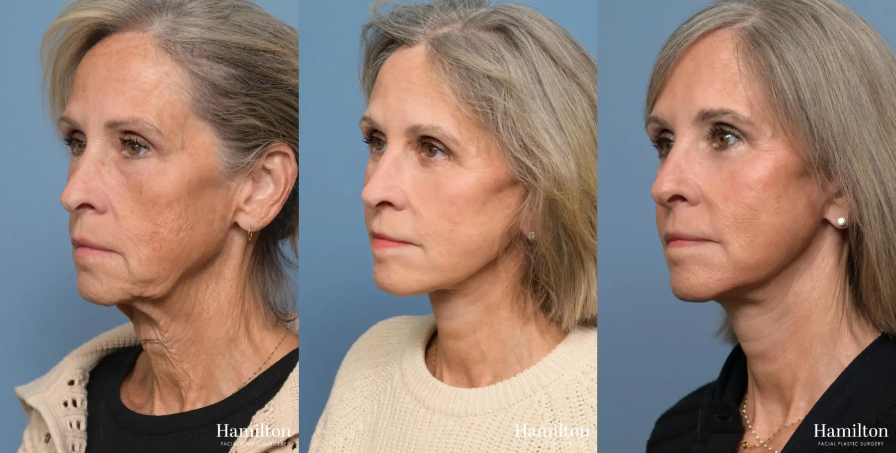 Facelift: Patient 8 - Before and After 4