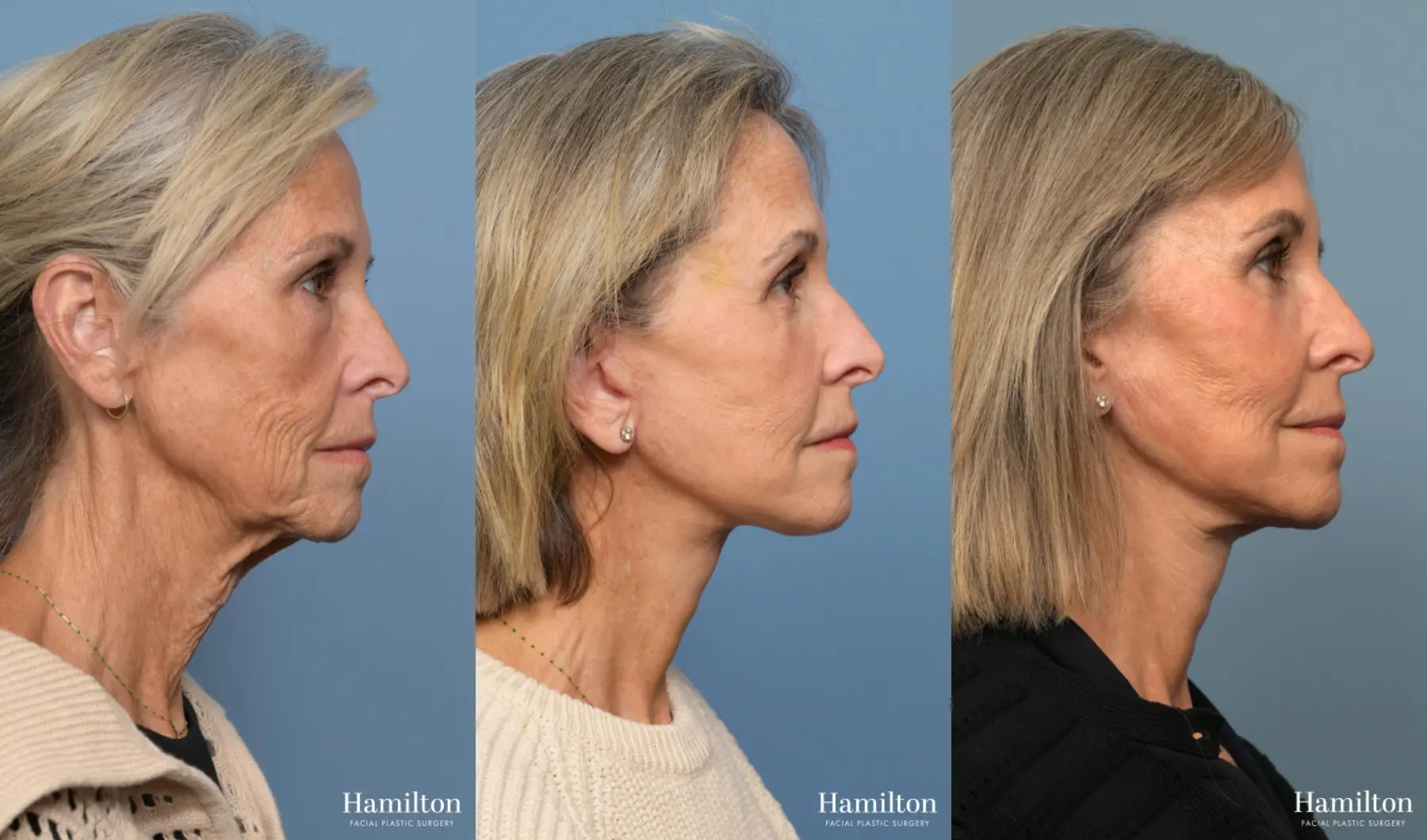 Facelift: Patient 8 - Before and After 3