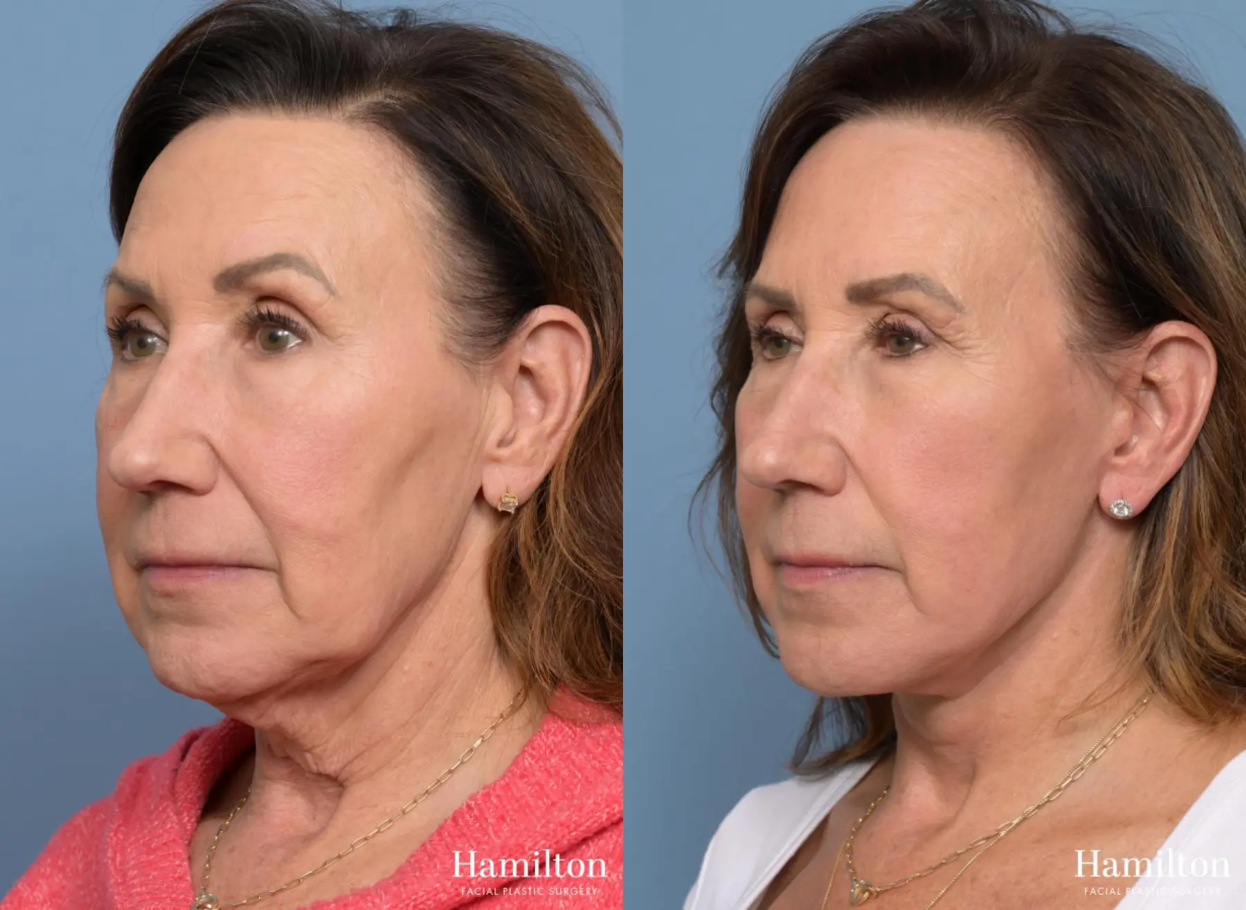 Facelift: Patient 9 - Before and After 5
