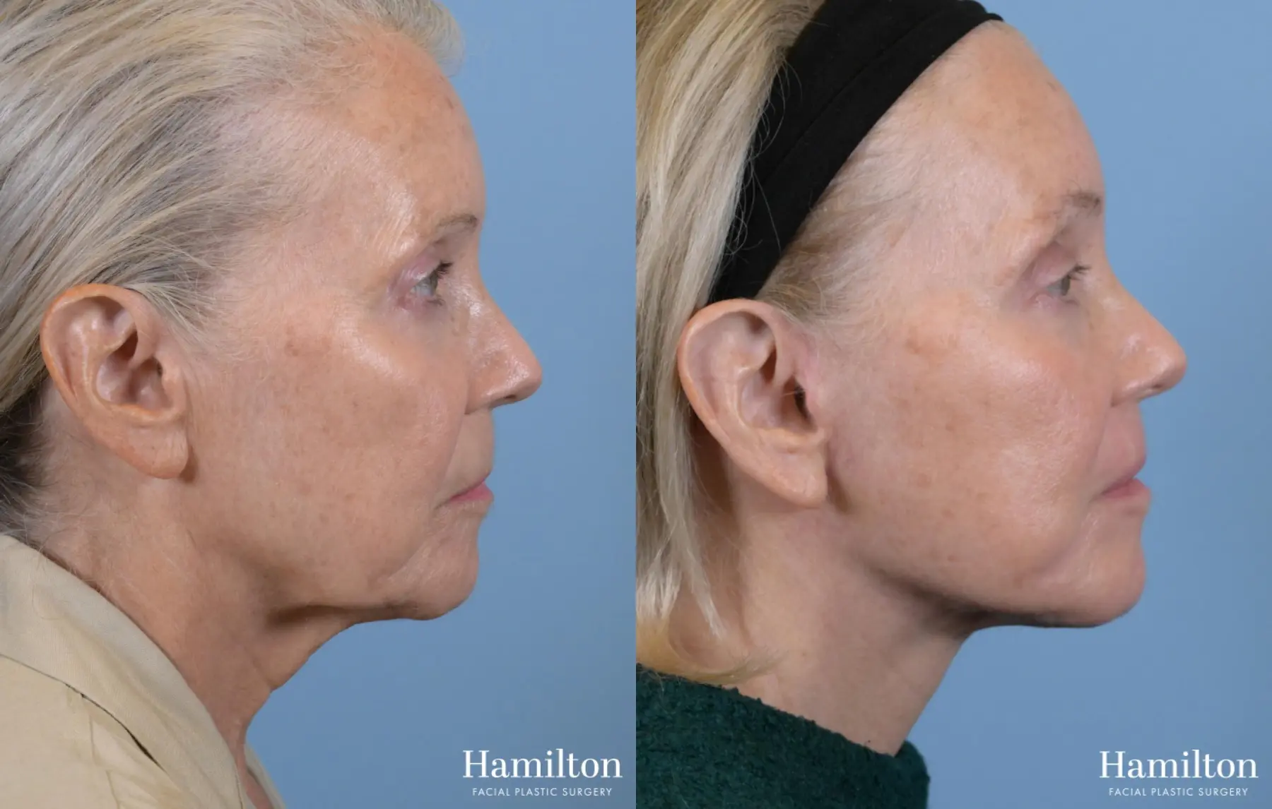 Facelift: Patient 3 - Before and After  