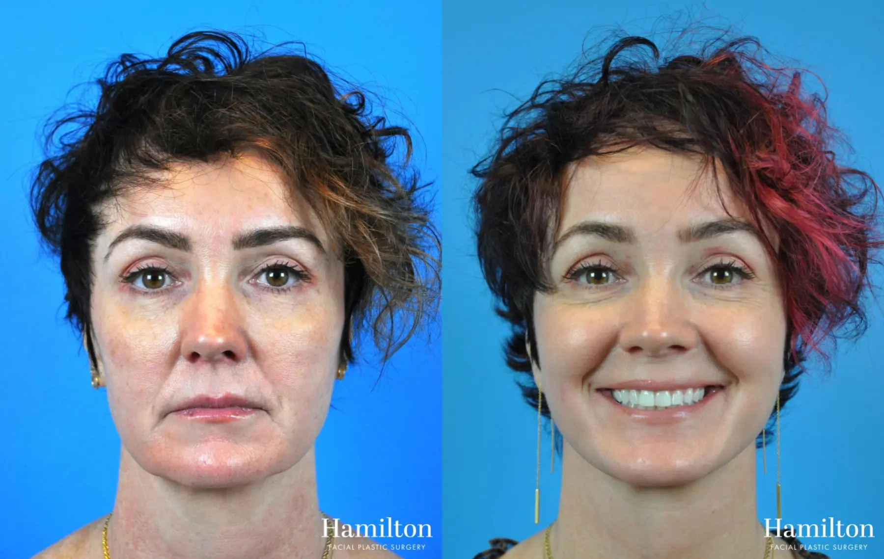 Facelift: Patient 12 - Before and After 4